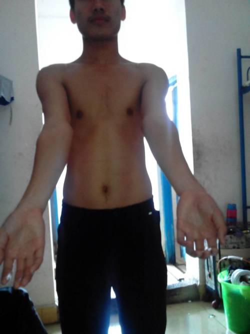 肘外翻20度，兵检的考验与突破，肘外翻20度，兵检的挑战与突破之路